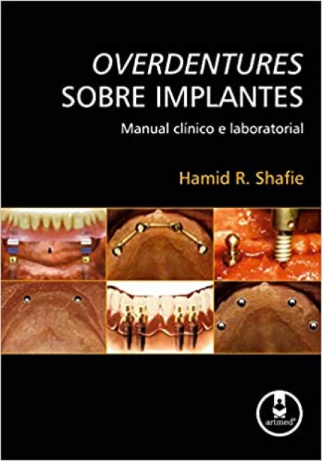 OVERDENTURES SOBRE IMPLANTES:MN. CLIN. E LAB.