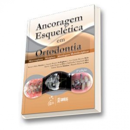 Ancoragem Esquelética em Ortodontia - Mini-implante - Miniplaca - Abordagem Multidisciplinar - 2ª/2013