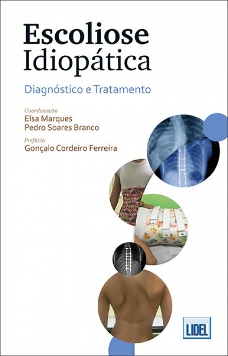 ESCOLIOSE IDIOPÁTICA - diagnostico e tratamento